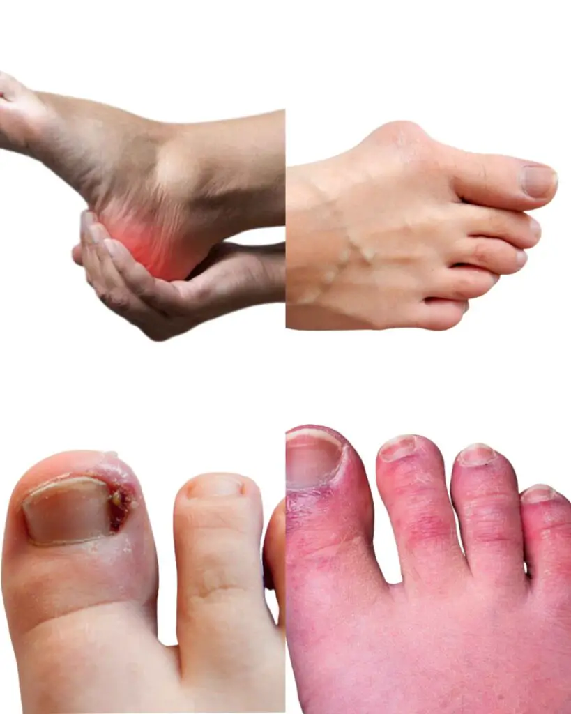 Effects of Ill-fitting shoes on toes
